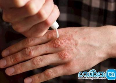 چرا پسوریازیس با بیماری های مفصلی مرتبط است؟ چرا پسوریازیس با بیماری های مفصلی مرتبط است؟